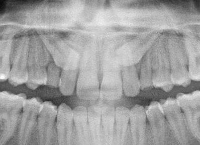 Impacted canines not shown on CBCT

