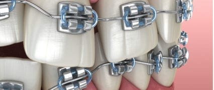 orthodontic alignment