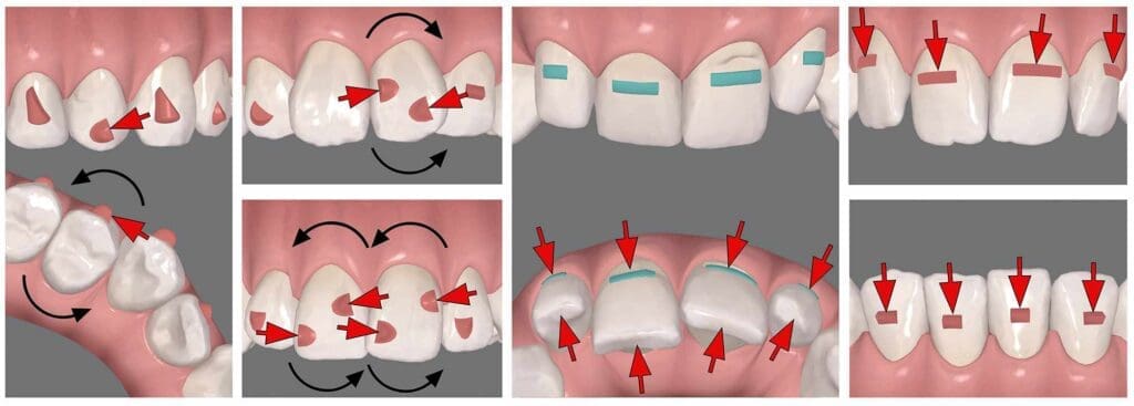 Aligner attachments