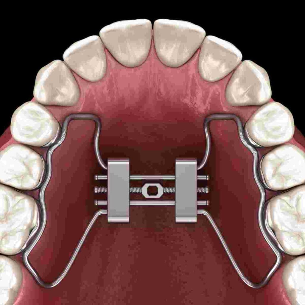 adenotonsillectomy